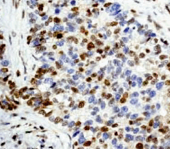 Image:  Immunohistochemical analysis of paraffin-embedded human breast carcinoma stained with p27 KIP 1 antibody (Photo courtesy of Abcam).